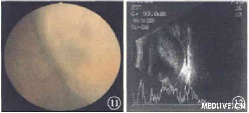 ͼ11����������ƺ�1�����۲�ɫ�۵��񡣱��Ϸ�����Ĥ�»ư�ɫ������������ ͼ12���ƺ�1������B�ͳ�������񡣱��Ϸ��ܱ�����Ĥ�²������������ڻ�����