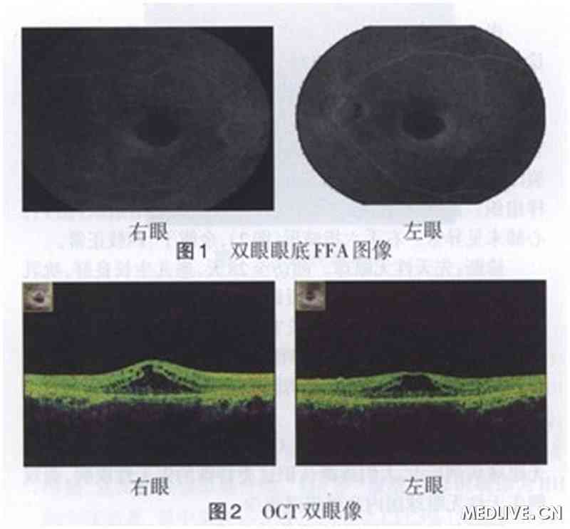 ͼ1 ˫���۵�FFAͼ�� ͼ2 OCT˫��ͼ��