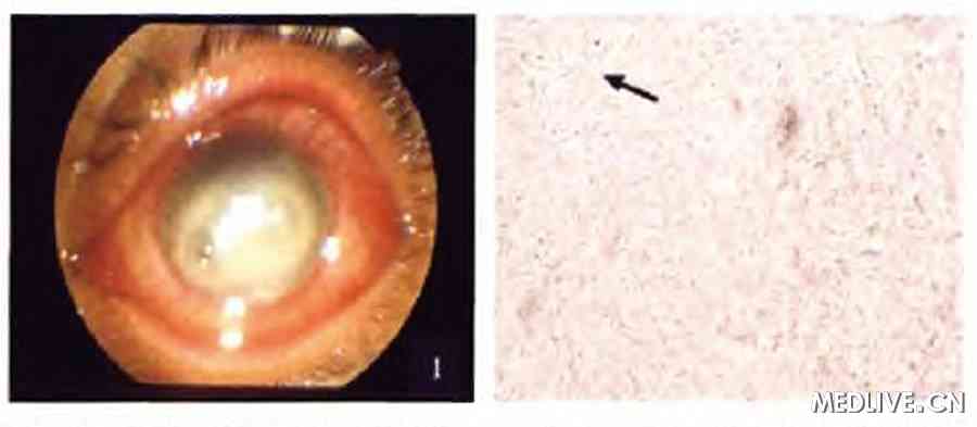 ͼ1��Ժʱ������ǰ����Ƭ ͼ2 ����KOHʪƬ�������