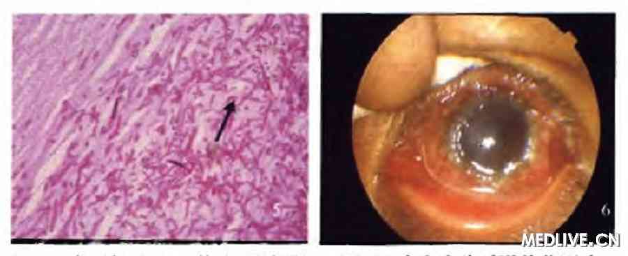 ͼ5 ������ƬPASȾɫ������̬ ͼ6���˳�Ժʱ��ǰ��ͼƬ