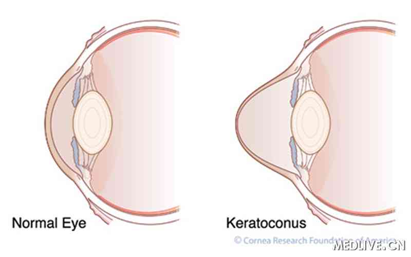 首诊为视神经乳头炎的圆锥角膜一例