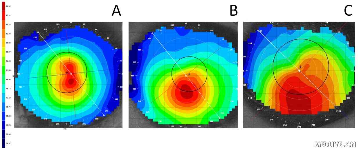 ��Ĥ����ͼ Բ׶��Ĥ