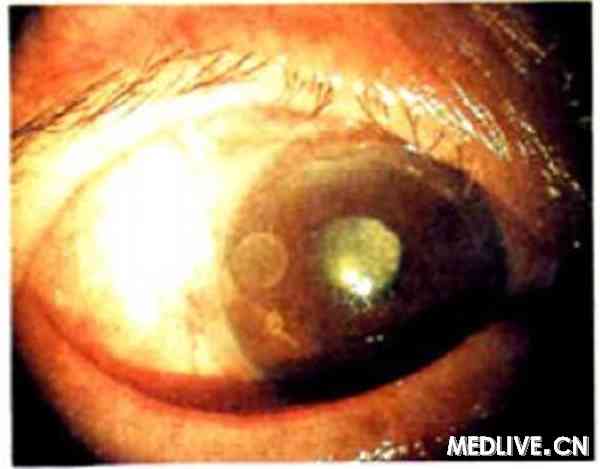 ������������ҩ�ྭ��Ĥ�пڽ���ǰ��һ��