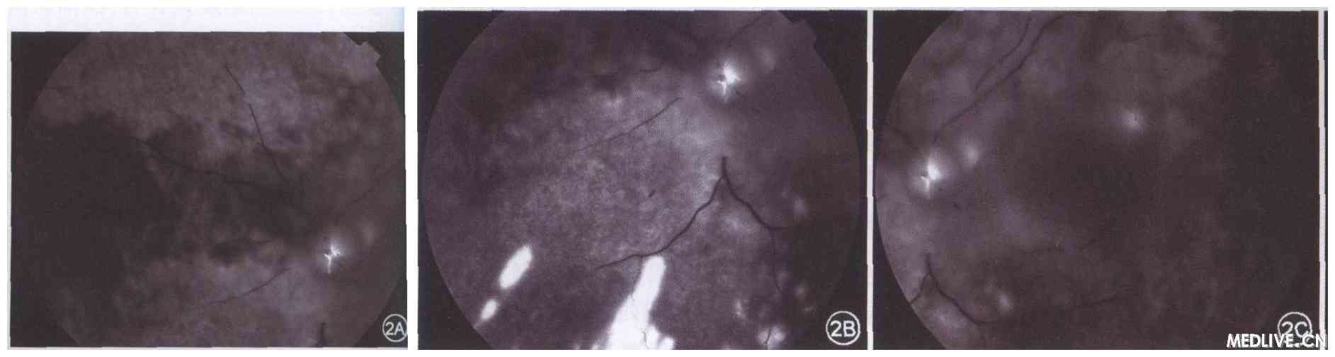 ͼ2���۶�����������ӫ�����۵�Ѫ����Ӱͼ��