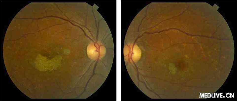 Stargardt���۵�