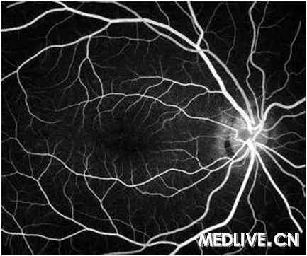 Stargardt�� ӫ������Ӱ