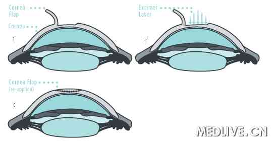 �����������LASIK������ӻ��˵��о�