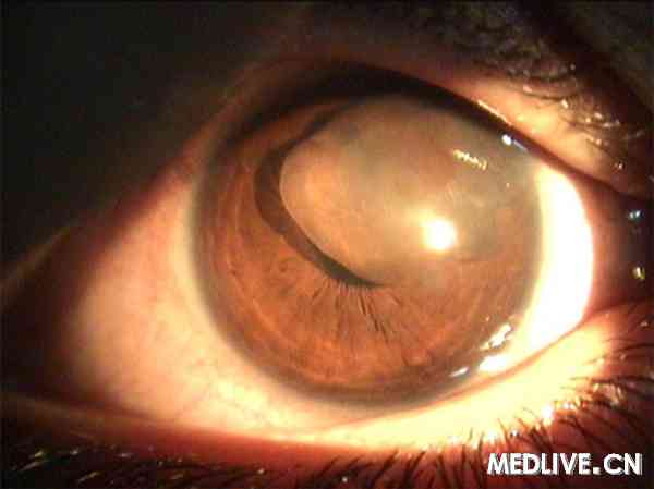 BMJ Case Reports��11���ͯ�ľ޴��Ĥ����