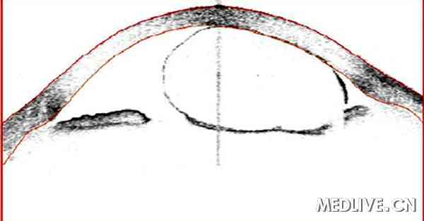 BMJ Case Reports��11���ͯ�ľ޴��Ĥ����