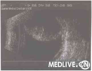 С���г����з���������Ĥ��ǻ��Ѫһ��