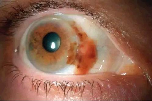 ���������۾��ĺڱ䲡