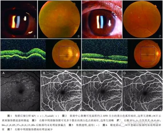 ������������ҹ������ģ��1�꣬��Ĥ�޳�Ѫ����״��͸����������͸������