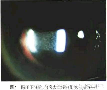 �������������ϳ����黯IOLֲ������������Ѹ���½�