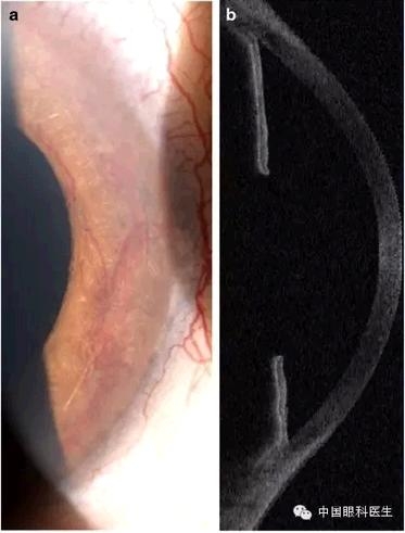 ��������ѪҺ͸�����¼�������۷���