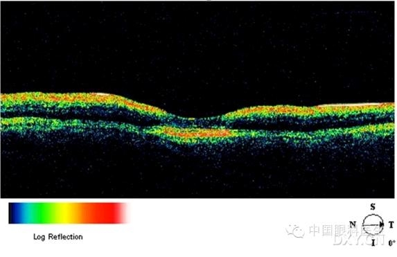 �ۿƾ���������ͬ����µ�OCT��ͼ