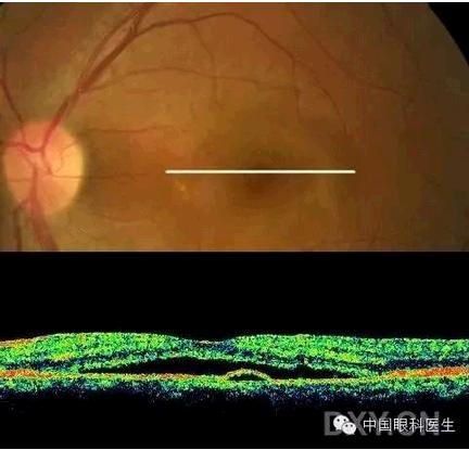 �ۿƾ���������ͬ����µ�OCT��ͼ