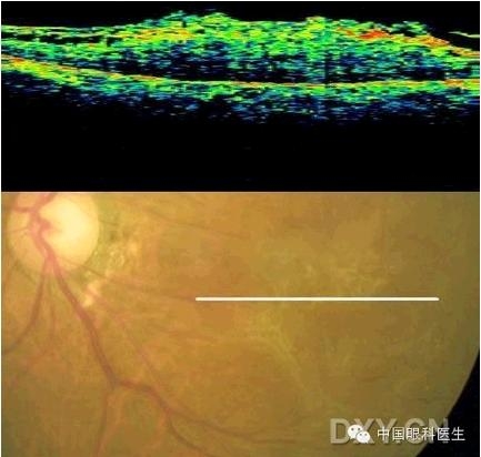 �ۿƾ���������ͬ����µ�OCT��ͼ