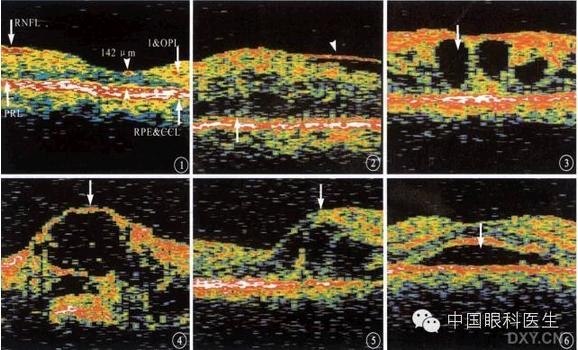 �ۿƾ���������ͬ����µ�OCT��ͼ