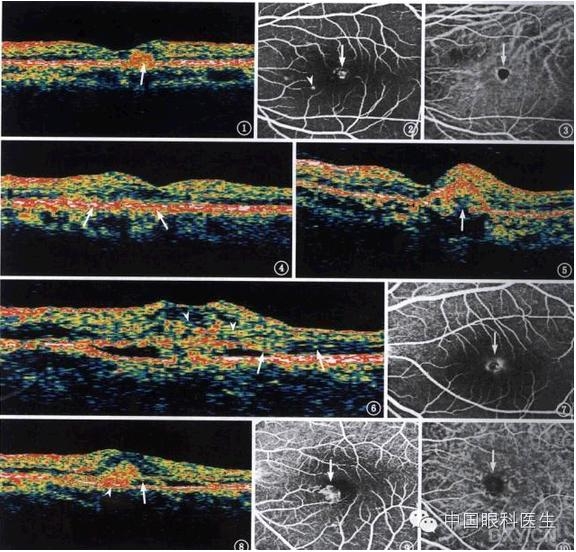 �ۿƾ���������ͬ����µ�OCT��ͼ