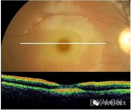 �ۿƾ���������ͬ����µ�OCT��ͼ