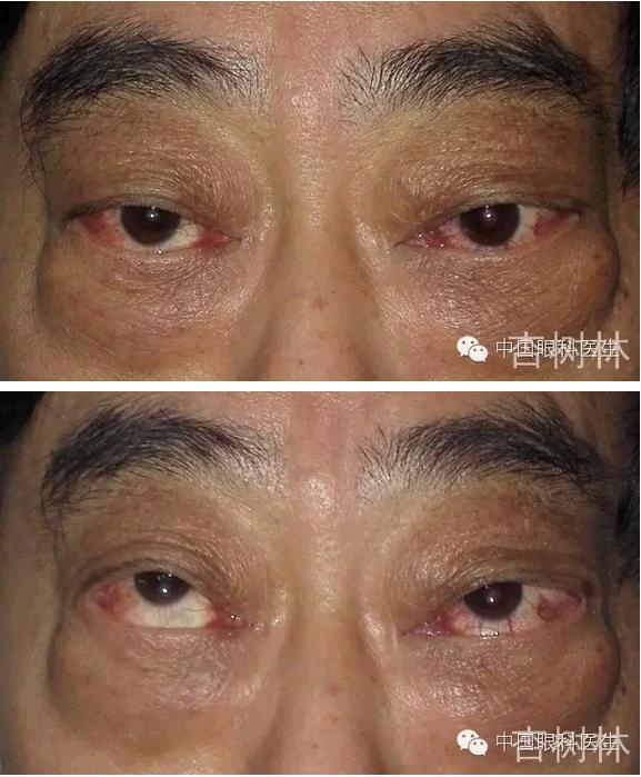 ����������״���۲��������ʹ��Ƥ����̴�����