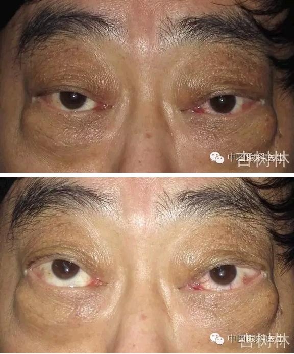 ����������״���۲��������ʹ��Ƥ����̴�����