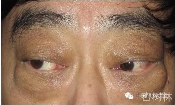 ����������״���۲��������ʹ��Ƥ����̴�����