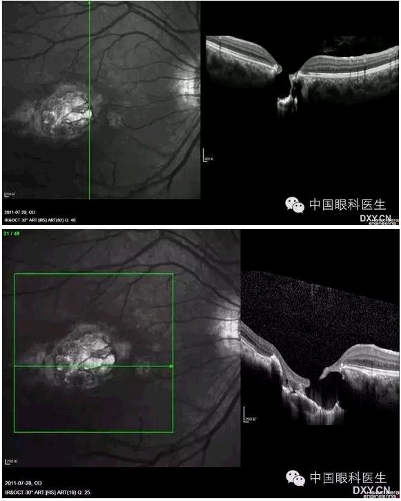 OCT����Ĥ�����Ӧ��ϵ