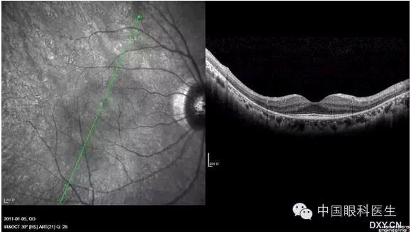 OCT����Ĥ�����Ӧ��ϵ