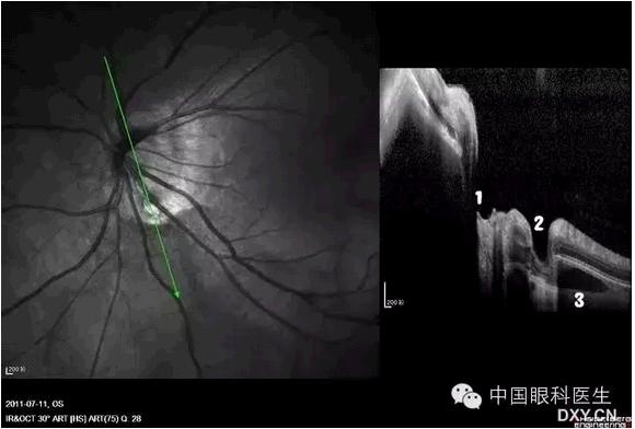 OCT����Ĥ�����Ӧ��ϵ