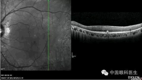 OCT����Ĥ�����Ӧ��ϵ