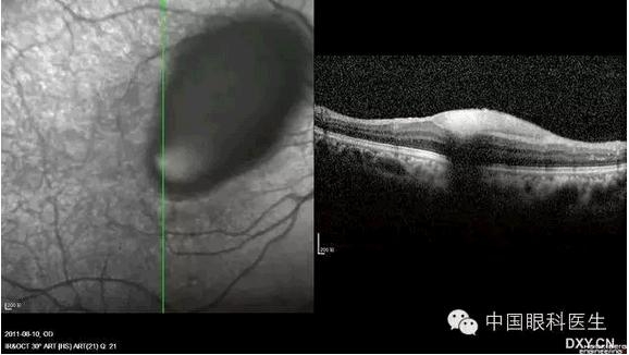 OCT����Ĥ�����Ӧ��ϵ