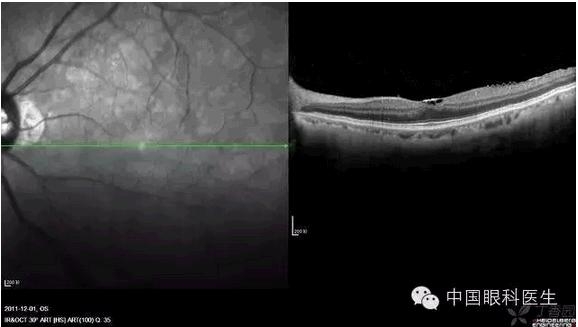 OCT����Ĥ�����Ӧ��ϵ