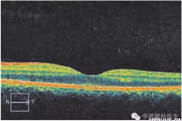 ��������11���к������� ��Ϊ��Ĥ��ɫ֢