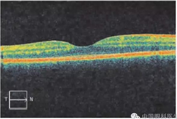 ��������11���к������� ��Ϊ��Ĥ��ɫ֢