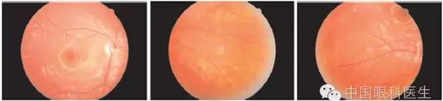 ��������11���к������� ��Ϊ��Ĥ��ɫ֢