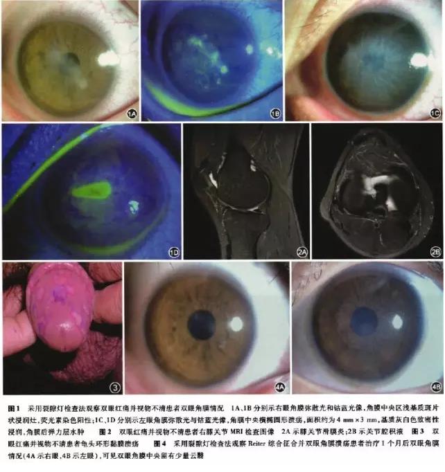 ��������Reiter�ۺ����ϲ���Ĥ����һ��