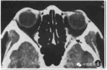 ͼ�Ľ�˵����η����ۿ�CTƬ