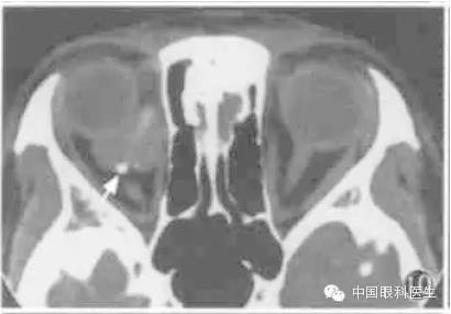 ͼ�Ľ�˵����η����ۿ�CTƬ