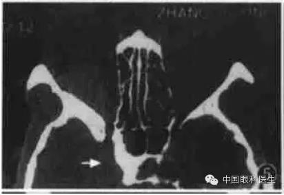 ͼ�Ľ�˵����η����ۿ�CTƬ