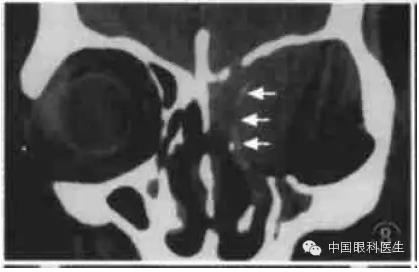 ͼ�Ľ�˵����η����ۿ�CTƬ