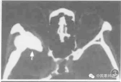 ͼ�Ľ�˵����η����ۿ�CTƬ