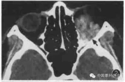 ͼ�Ľ�˵����η����ۿ�CTƬ