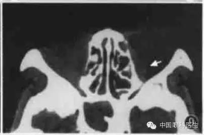 ͼ�Ľ�˵����η����ۿ�CTƬ