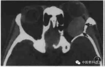 ͼ�Ľ�˵����η����ۿ�CTƬ