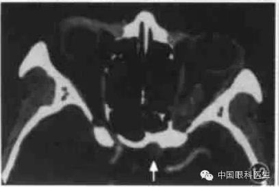 ͼ�Ľ�˵����η����ۿ�CTƬ