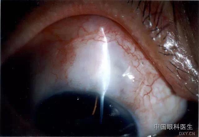 ������˹�����̬�ּ�����׼��Ƭ