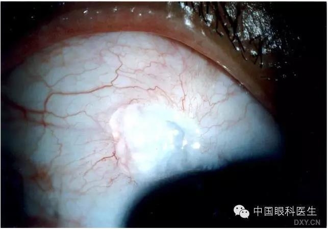 ������˹�����̬�ּ�����׼��Ƭ