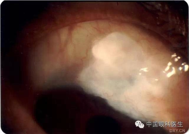 ������˹�����̬�ּ�����׼��Ƭ