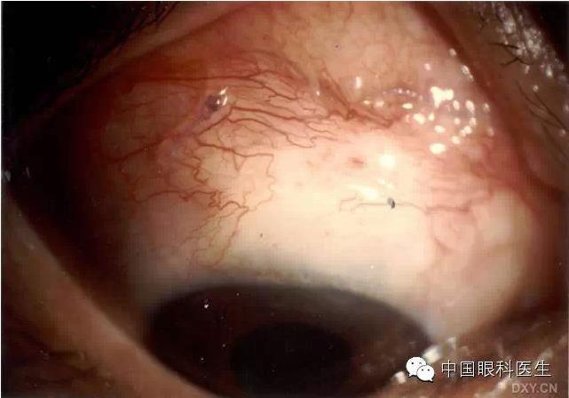 ������˹�����̬�ּ�����׼��Ƭ